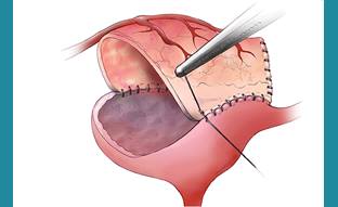 Colorectal Surgery