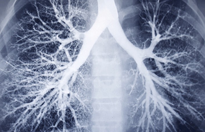 X-ray of lung