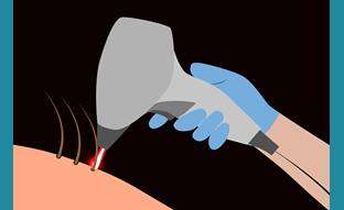 Treating Pilonidal Disease with Laser Hair Depilation