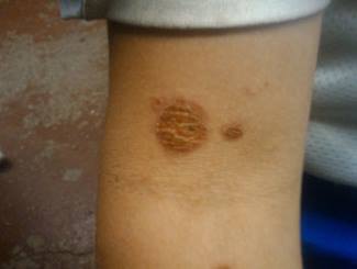 impetigo