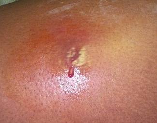 MRSA