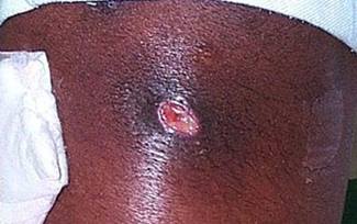 MRSA