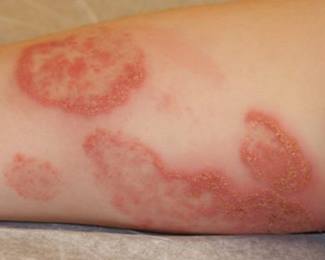 Ringworm