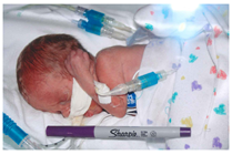 Gillian's Journey: One Micro-Preemie's Story of Hope