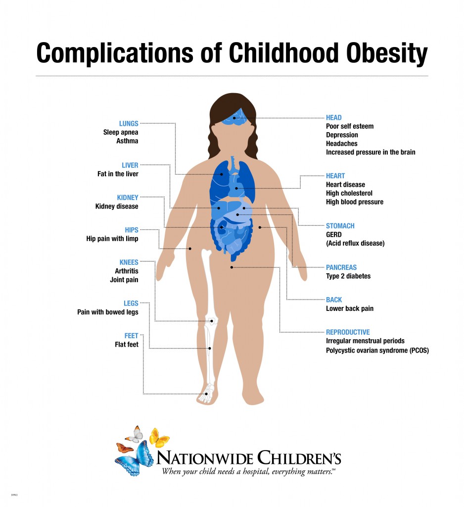 Childhood Obestity Inforgraphic