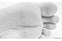 Warts: What They Are and How to Treat Them