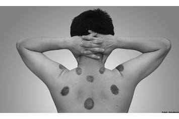 Child with marks on their back from cupping therapy