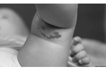 Birthmarks: When Should Parents Be Concerned?