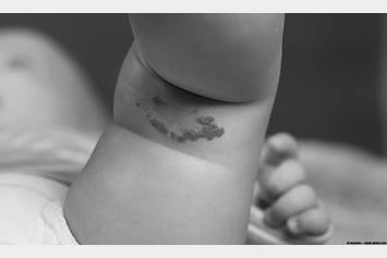 image of baby with birthmark on her leg