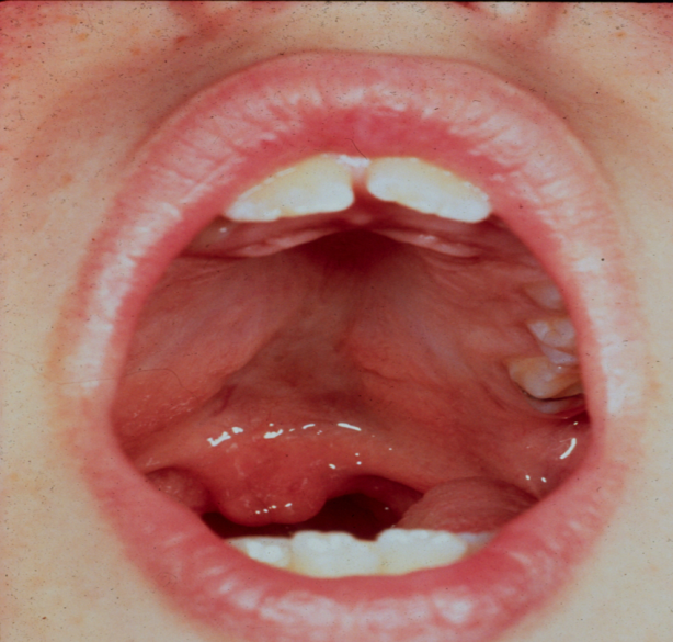 image of child with submucous cleft palate