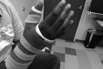 Broken Fingers: Why They Need Special Treatment and Care