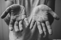 Hand-Foot-Mouth Disease: Causes, Symptoms and Treatment