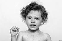 Measles Virus: Facts for Families