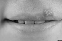 What You Need to Know About Herpes Mouth Sores