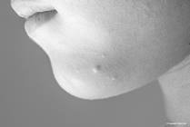 Molluscum Contagiosum: What You Need to Know