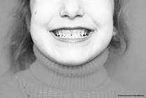 Underbite Correction with an Innovative Treatment