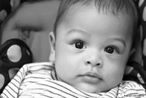 Prune Belly Syndrome: 5 Things to Know