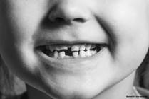 Palate Expanders: What Parents Need to Know