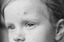 Monkeypox, Now Mpox, Is Spreading: What You Need to Know