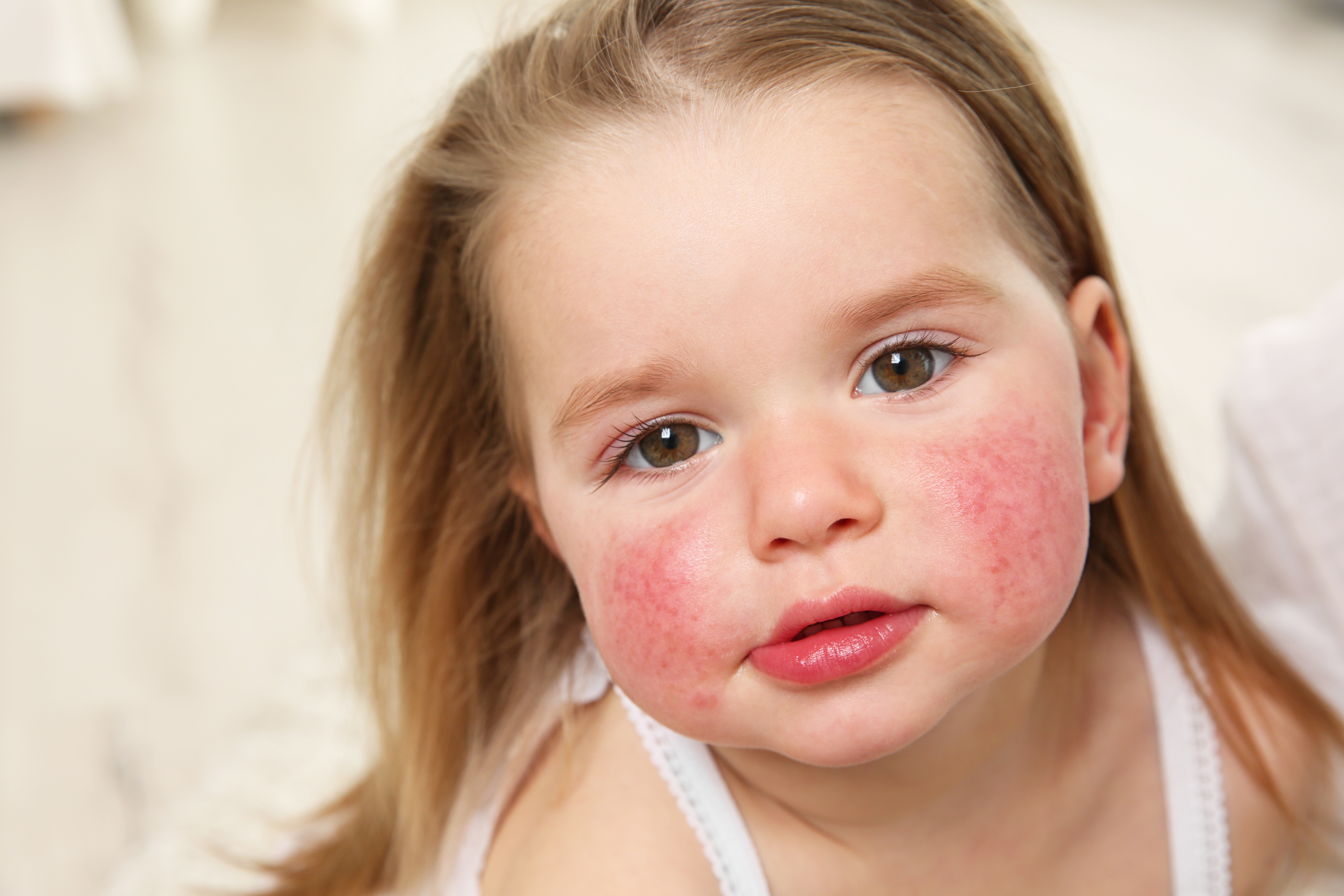 girl with face rash parvovirus