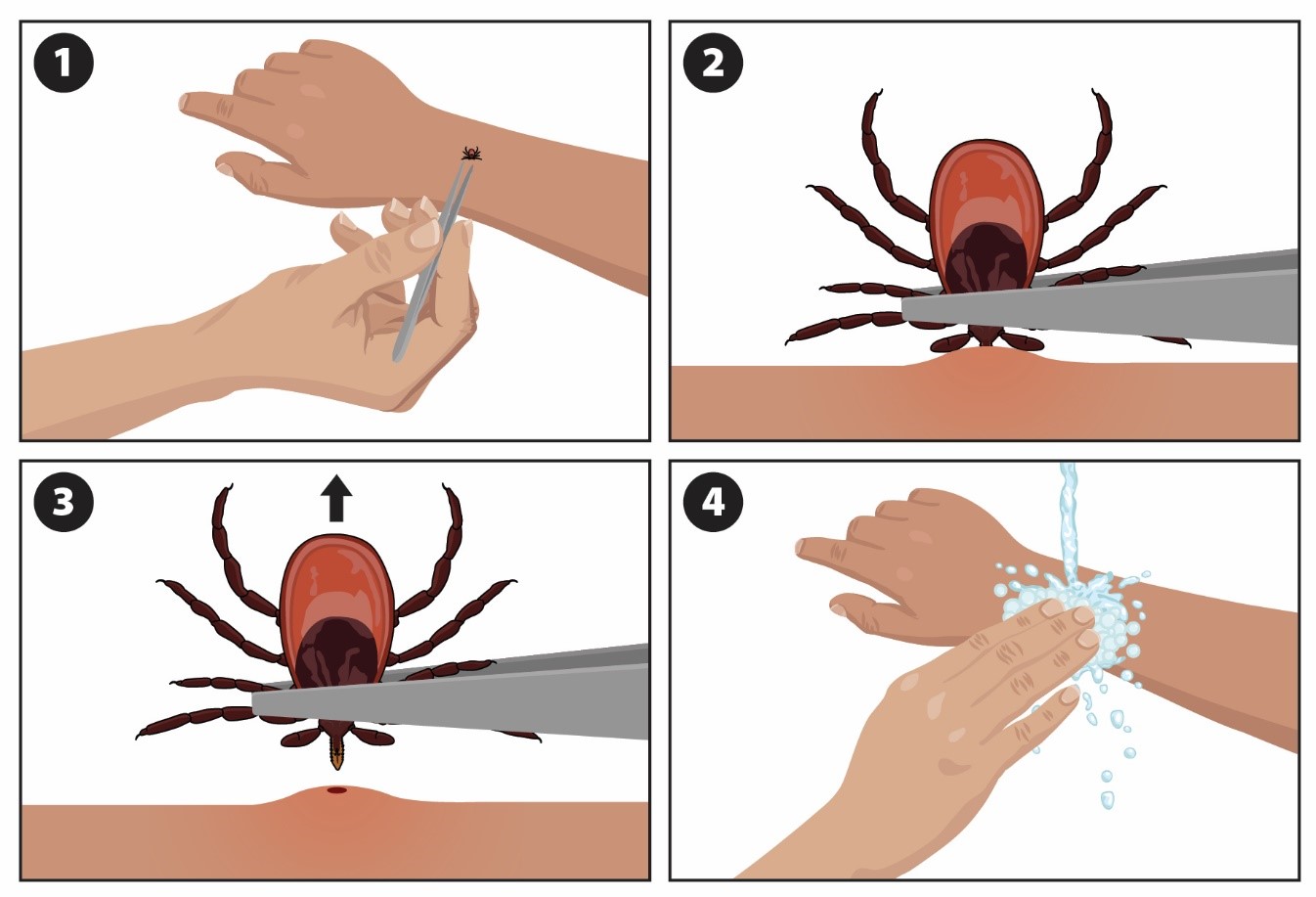 4 steps on how to extract a tick, safely
