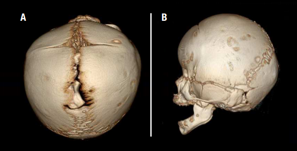 bilateral coronal craniosynostosis