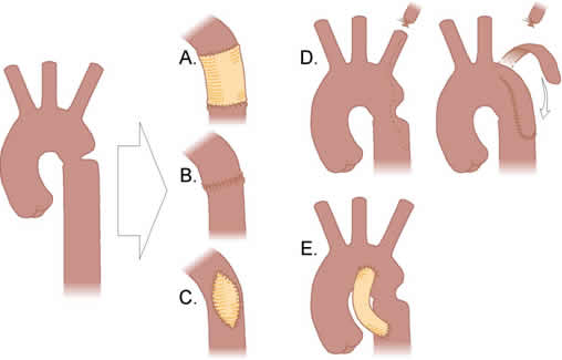 Coarctation Of The Aorta Diagnosis Treatment And Complications