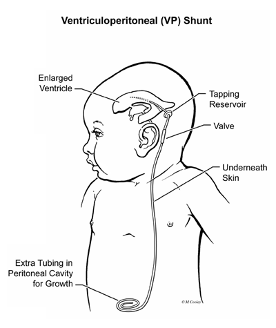 Dandy-Walker Syndrome