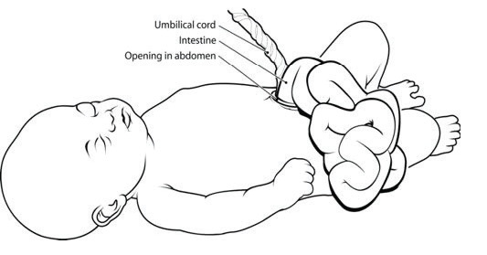 Gastroschisis