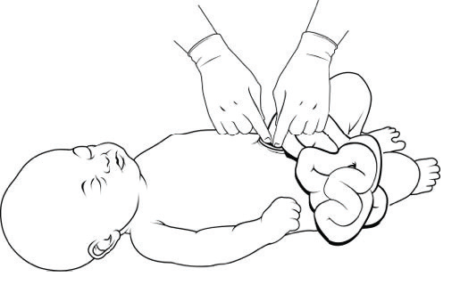 Gastroschisis