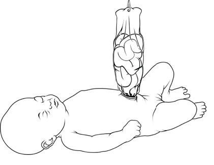 Gastroschisis