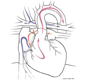 Hypoplastic Left Heart Syndrome Comprehensive Stage 2