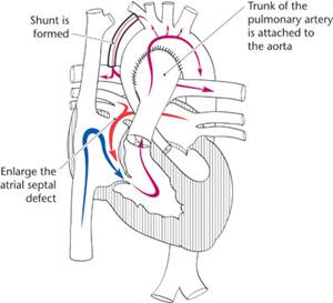 Hypoplastic Left Heart Syndrome Norwood Procedure
