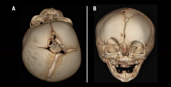 unilateral coronal craniosynostosis