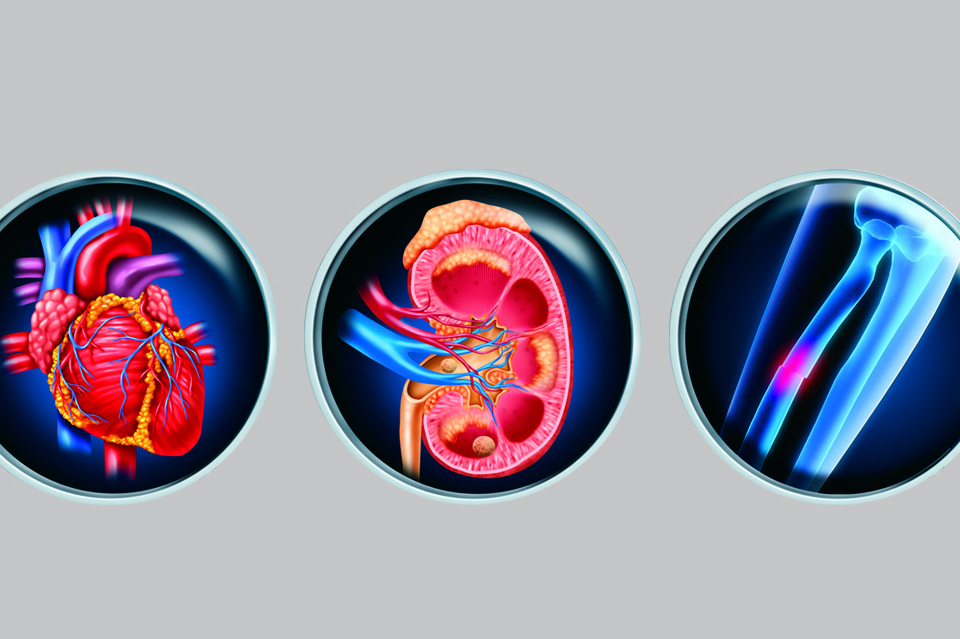 Childhood Kidney Stones