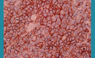 Ewings Sarcoma