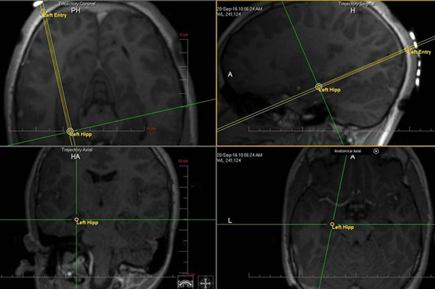 Minimally Invasive Technology in Epilepsy Procedures