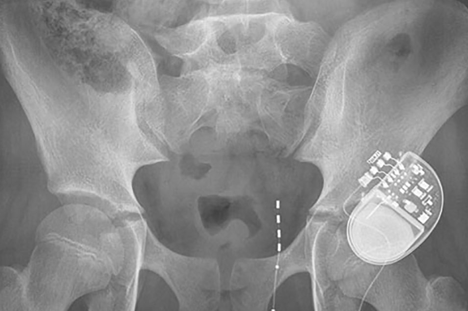 Pediatric Fecal and Urinary Incontinence