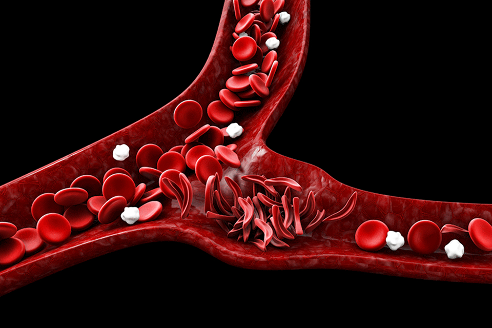 Stem Cell Transplant