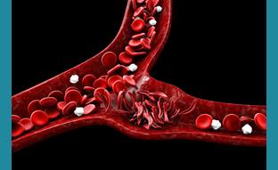 Stem Cell Transplant