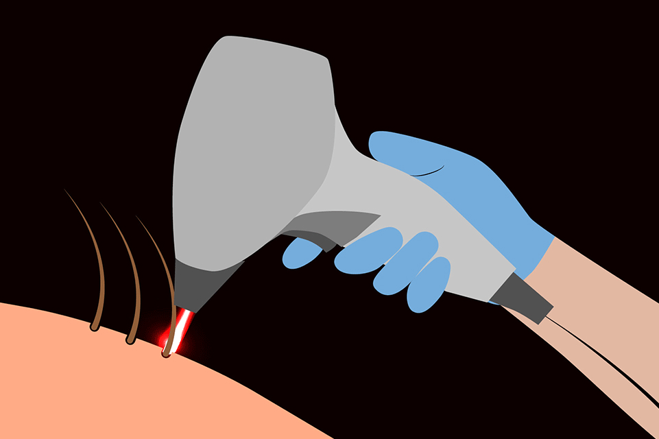 Treating Pilonidal Disease with Laser Hair Depilation