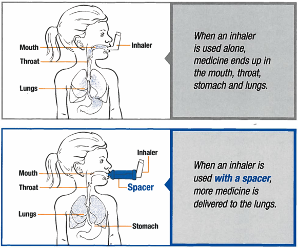 Image showing two diagrams to demonstrate how a spacer helps deliver more medicine to the lungs than using an inhaler without a spacer.