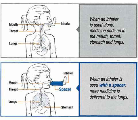Image showing two diagrams to demonstrate how a spacer helps deliver more medicine to the lungs than using an inhaler without a spacer.