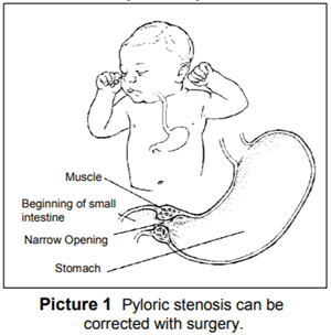 Pyloric stenosis