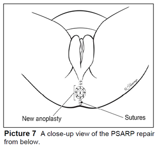 A close-up view of the PSARP repair from below. 
