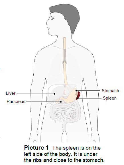 Sickle Cell Disease And Signs Of Spleen Crisis Splenic Sequestration