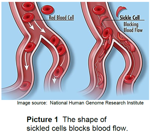Sickle Cell Disease and Pain