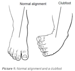 difference between normal alignment and clubfoot