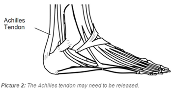 the Achilles tendon on the back of the ankle