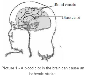 blood clot in the brain